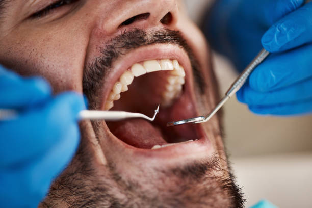 Best Emergency Wisdom Teeth Removal in Caldwell, OH